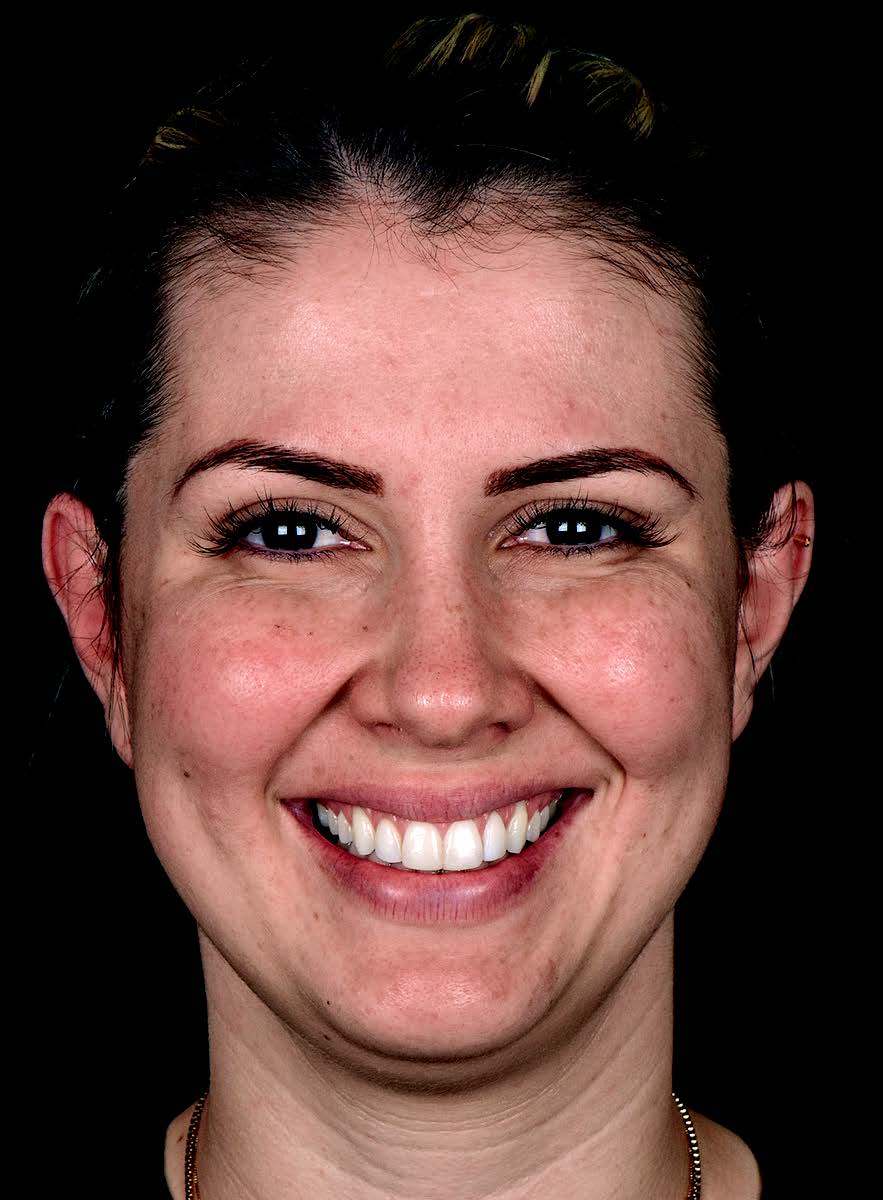 Sourire après traitement par neuromodulateurs