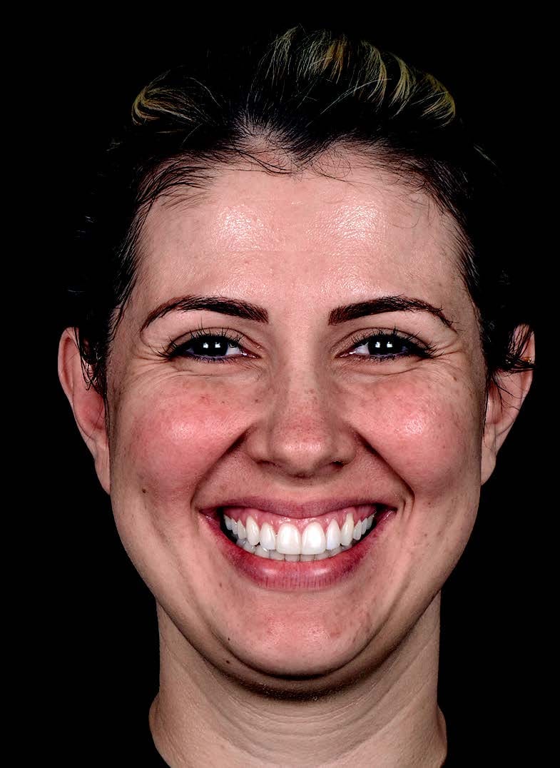 Sourire gingival avant traitement