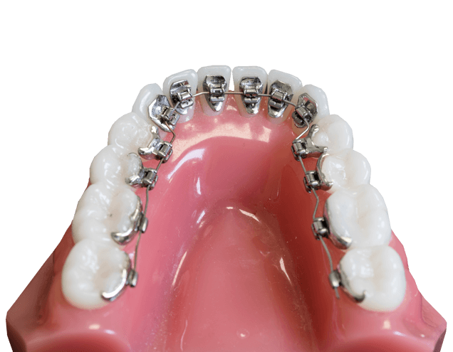 Lingual orthodontic brackets