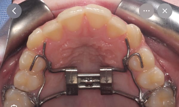 Palatal Expansion in Children: Why and How?