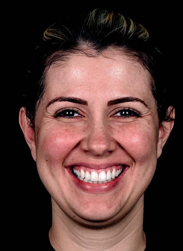 Sourire Gingival : Le Traitement par Neuromodulateurs (Botox)