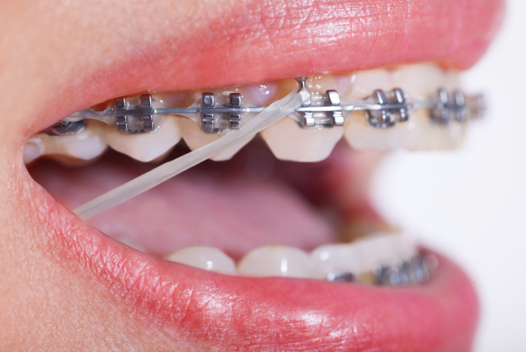 Orthodontic Elastics: Why They Break and How to Replace Them