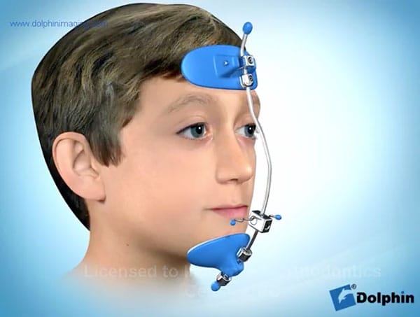 Masque facial orthodontique pour correction de l occlusion croisée antérieure